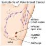 Breast cancer cases increased in Pakistan
