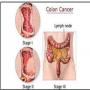 Kursi pr zyada dair bethnay sa aant k cancer ka khatra barh jata ha