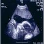 Avoid Pregnancy with Ultra Sound