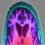 A successful test of killing alzheimers disease virus