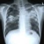 295 people of every 100 thousand pakistanis are sick with tuberculosis or TB disease