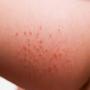 Woman Articles Rashes On Skin