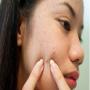 Easy to get rid of acne on their faces nail Household prescription