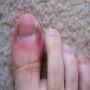 Toe nails can be a source of diseases identified