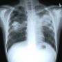 Causes Symptoms and precautions of tuberculosis formally called T.B